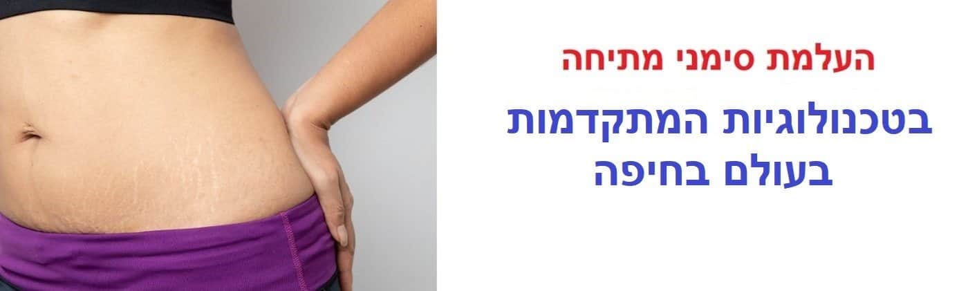 העלמת סימני מתיחה בחיפה