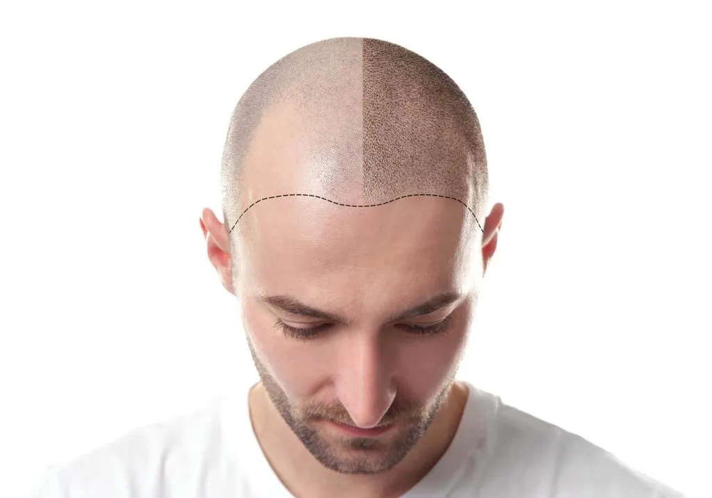 השתלת שיער בגאורגיה